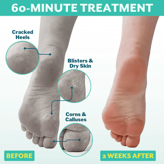 PoshPeel PediCure - 1 Treatment Box